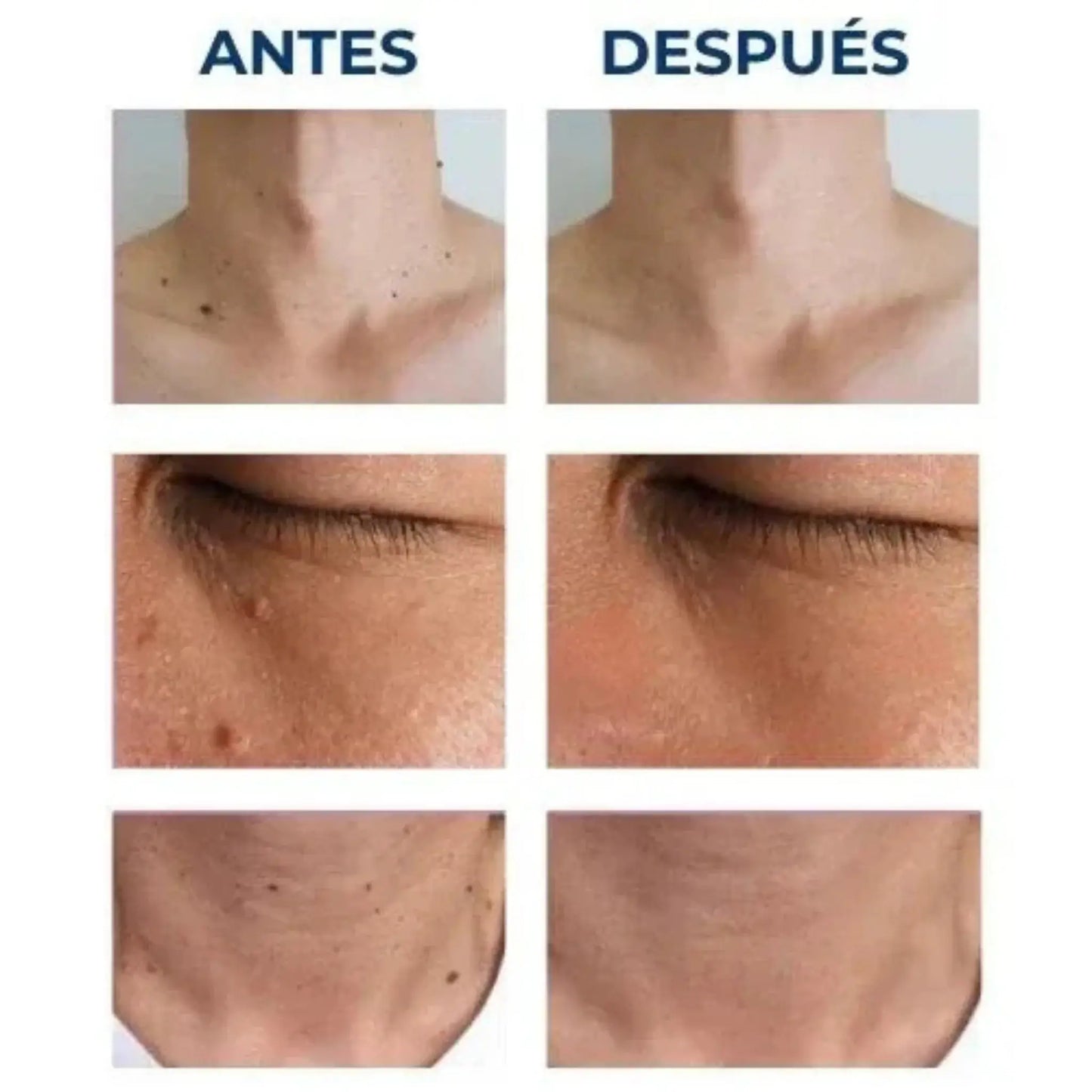 Luminiix® Eliminador de Verrugas – Fórmula Natural sin Dolor y sin Cicatrices
