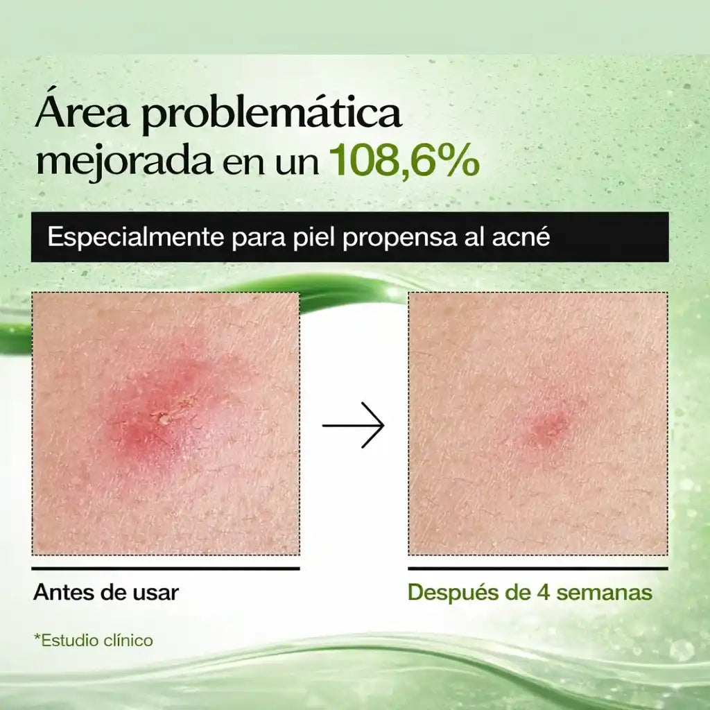 RedCalm™ Azelaic Serum – Suero Calmante con Ácido Azelaico para una Piel Más Uniforme